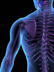 Scoliosis