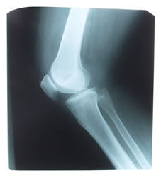 Arm Pain Elbow