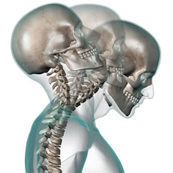 Neck Injury From Car Accident Somerville